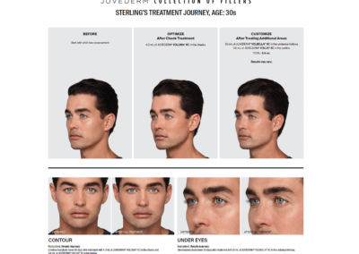 Juvederm Before and After - men