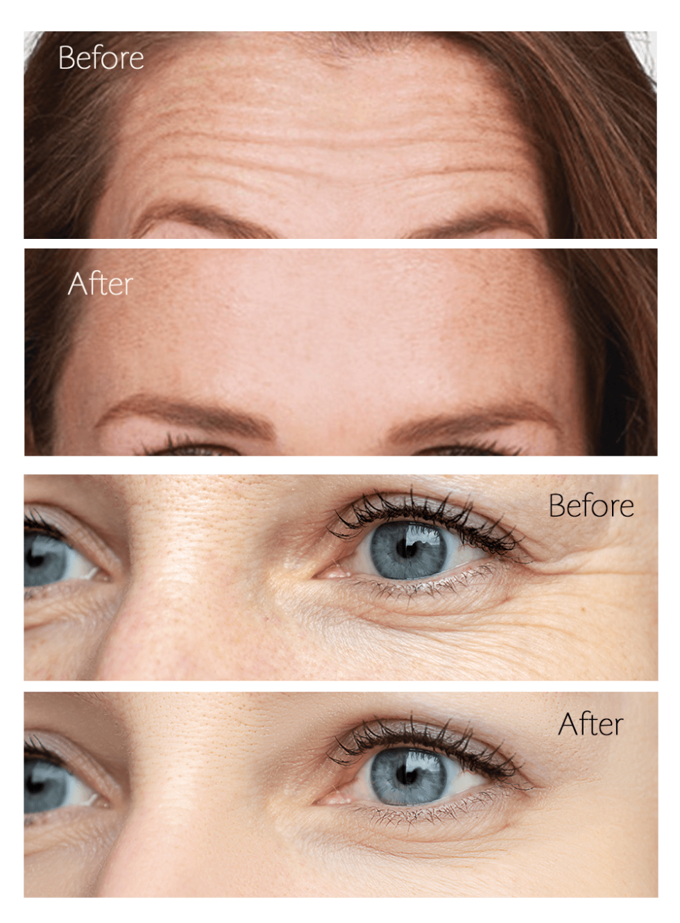 Before and After images of Botox neurotoxin treatment in corona ca